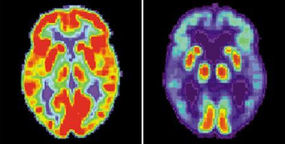 aging_brain.jpg